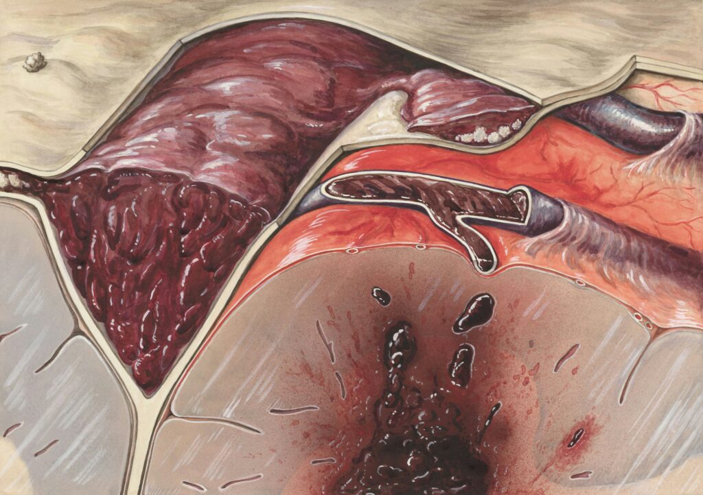 4 Stages of Appendicitis: Symptoms, Risks & What Each Stage Means