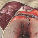 4 Stages of Appendicitis: Symptoms, Risks & What Each Stage Means