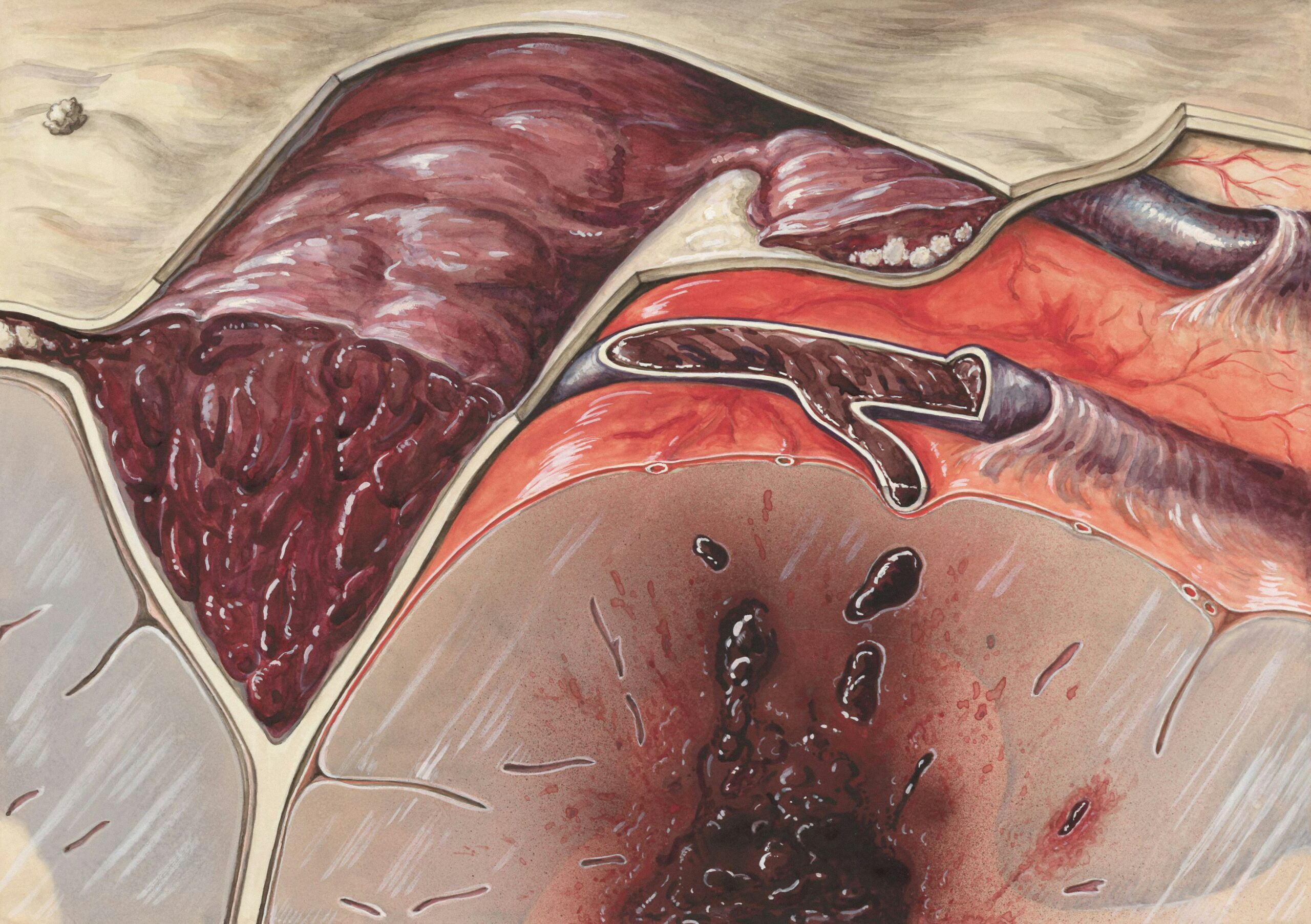 4 Stages of Appendicitis: Symptoms, Risks & What Each Stage Means